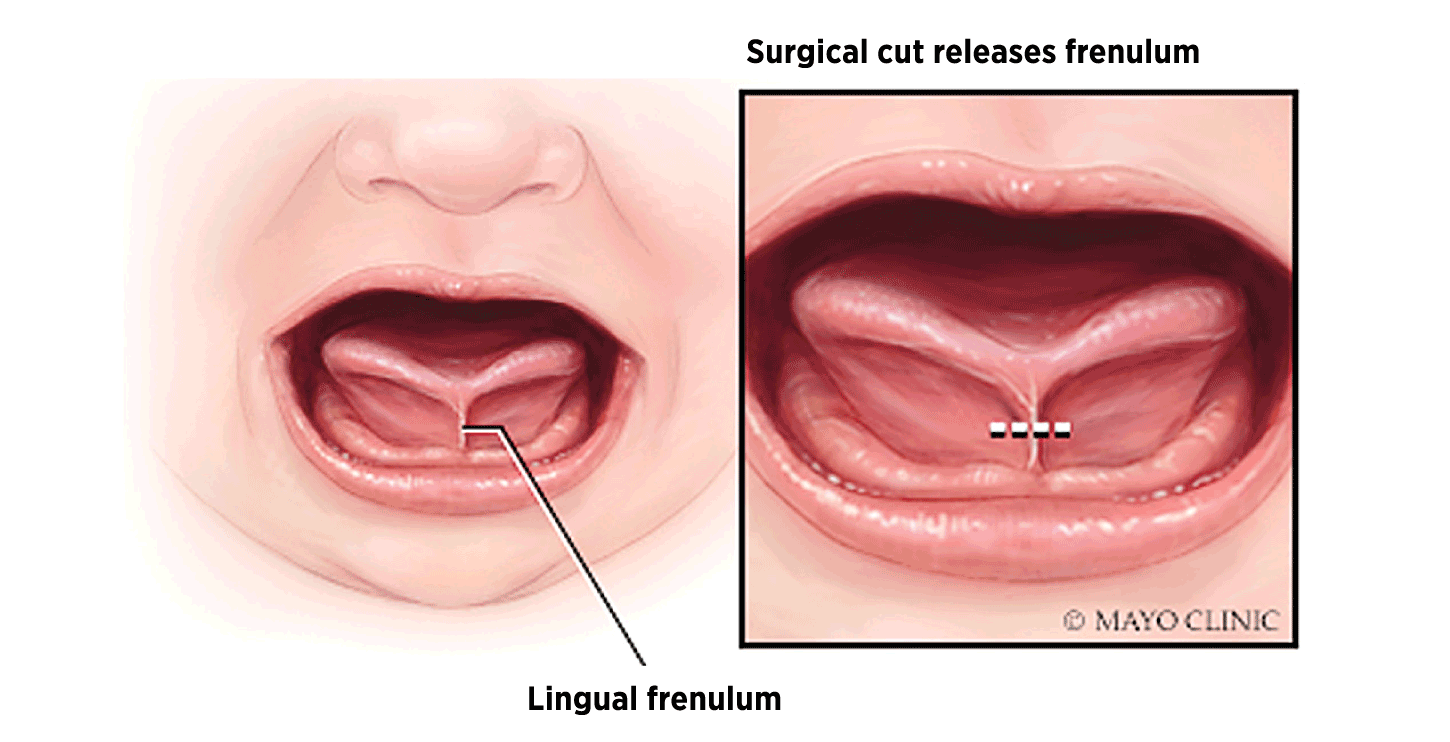 Frectomy Frenectomy - Periodontist in Birmingham, AL - Gum Disease Treatment